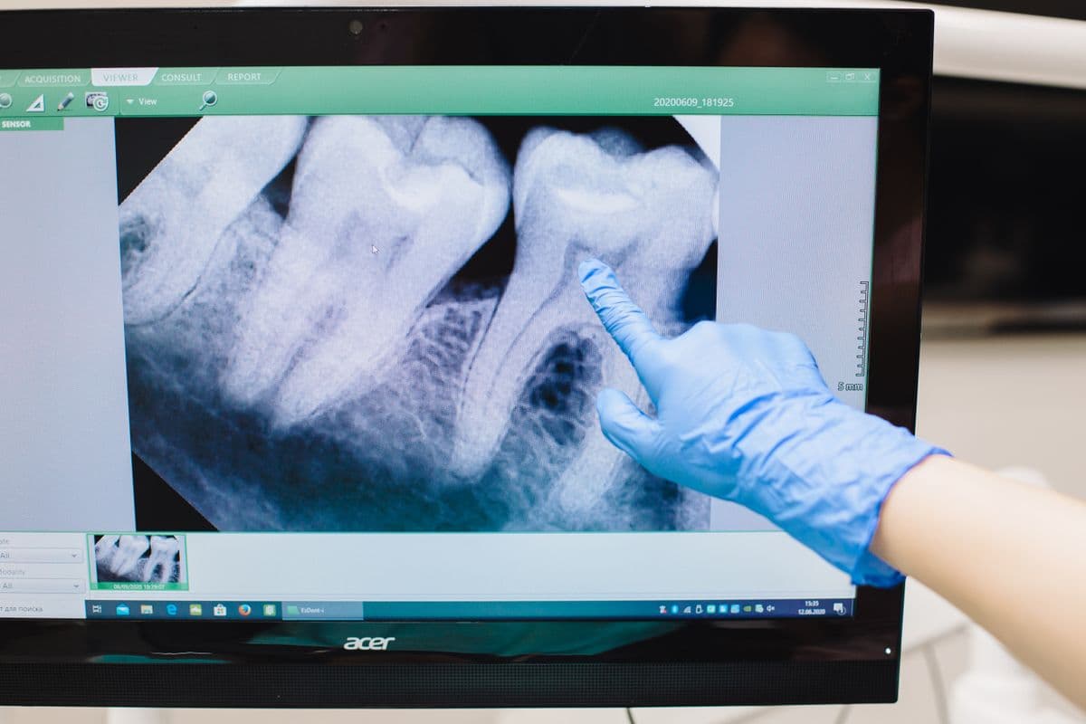 Dental X-ray on a monitor during dental implant planning in Vashi, Navi Mumbai